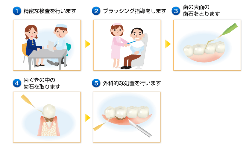 歯周治療の流れイメージ